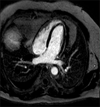 Hemopericardium