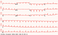 varying amplitudes of the QRS