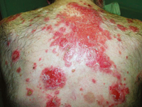 Pemphigus vulgaris