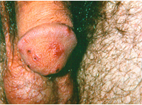 Scabies Erythematous