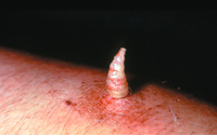 Furuncular myiasis