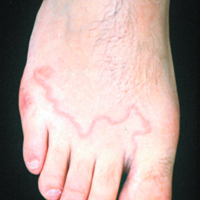 Cutaneous larva migrans