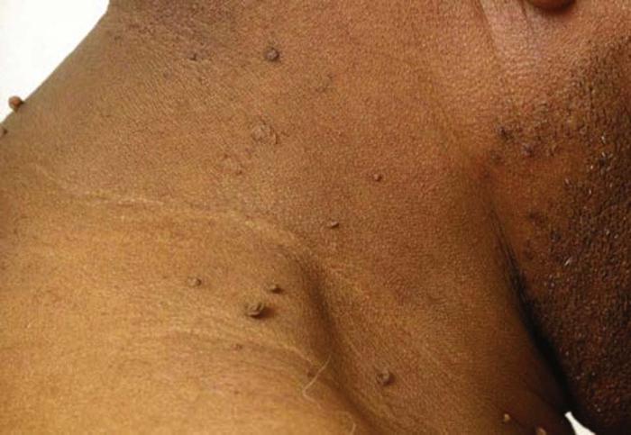 Armpit Lump: Causes, Diagnosis & Treatment - Healthline