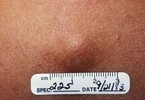 Epidermal inclusion cyst.