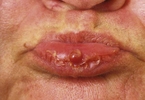 Pyogenic granuloma.