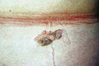 Seborrheic keratosis.