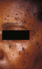 Dermatosis papulosa nigra.