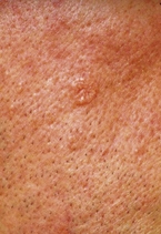 Sebaceous hyperplasia.