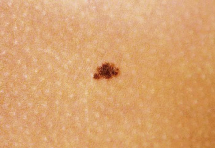 benign nevus