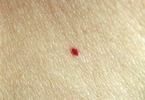 Cherry angioma.