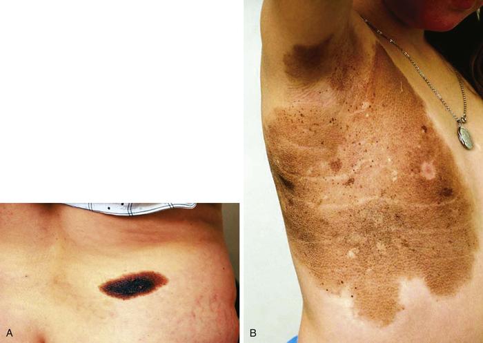 superficial spreading malignant melanoma