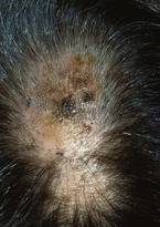 Superficial spreading melanoma within plaque of lichen planopilaris.