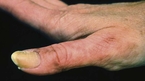 Acral lentiginous melanoma on the right thumb.