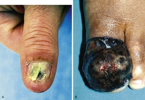 A, Subungual melanoma on the right thumbnail. B, Melanoma on the left toe.