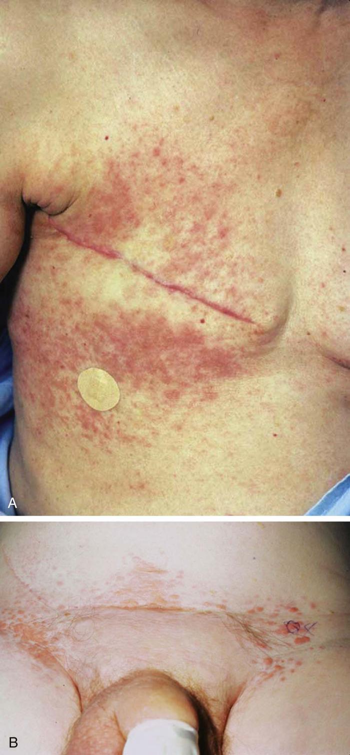 Pictures of common skin rashes, symptoms & treatments