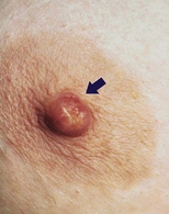 Paget's disease of the nipple in a middle-aged woman.