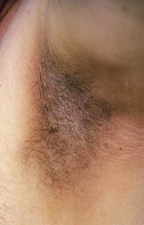 Acanthosis nigricans in the axilla of an obese man.