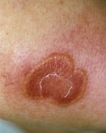 An erythematous edematous plaque on the arm of a woman with Sweet's syndrome.