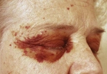 Pinch purpura in a woman with systemic amyloidosis.