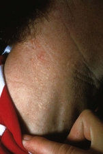 Yellow papules on the neck of a boy with pseudoxanthoma elasticum.
