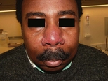Flesh-colored to erythematous nodules and plaques on the nose of a man with sarcoidosis (lupus pernio).