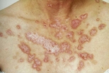 Atrophic red plaques of discoid lupus in a young woman.