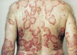 Annular plaques on the back of a man with subacute cutaneous lupus.