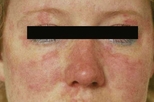 Malar erythema in a young woman with lupus.