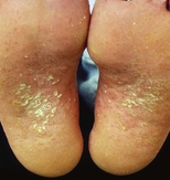 Pustules and crusted papules on the soles (keratoderma blennorrhagicum) of a young man.