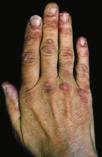 Gottron's papules on the hands of a woman with dermatomyositis.