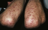 Pruritic papules on the elbows of a man with dermatitis herpetifomis.