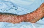 Leukocytoclastic vasculitis on the leg of a hospitalized patient.