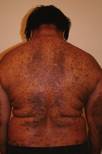 Generalized lichen planus on the back of a woman.