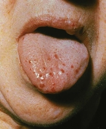 Telangiectasia on the tongue of a patient with Osler-Weber-Rendu syndrome.
