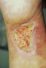 Ulcer of pyoderma gangrenosum in a man.