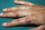 Targetoid plaques on the dorsal surface of the fingers.