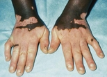 Vitiligo on the hands.