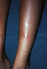 Erythema nodosum on the leg of a young woman.