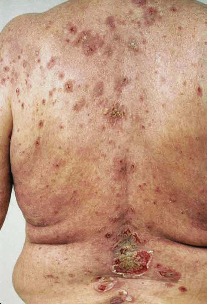 Dermatologic Signs of Systemic Disease