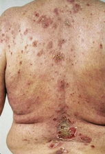 Eroded bullae on the back of an elderly man with pemphigus vulgaris.