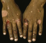 Bullae and erosions on the hands are characteristic of epidermolysis bullosa acquisita.