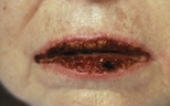 Severe stomatitis in a woman with paraneoplastic pemphigus.