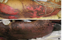 patient with toxic epidermal necrolysis