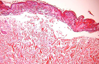 histologic findings of toxic epidermal necrolysis