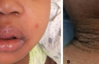 child with staphylococcal scalded skin syndrome