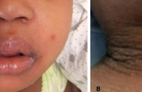 child with staphylococcal scalded skin syndrome