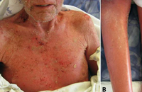 Erythroderma secondary to toxic shock syndrome.