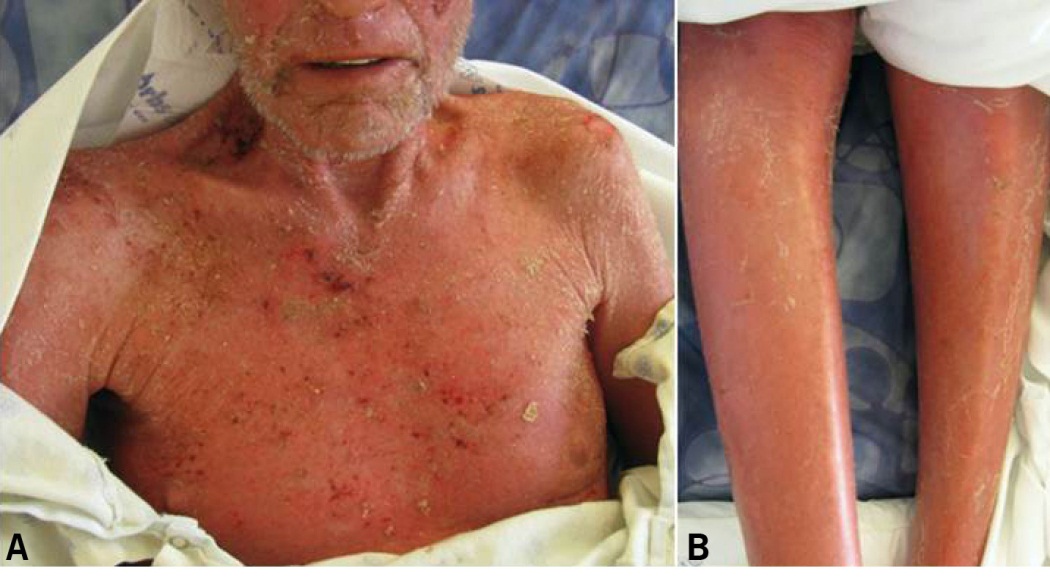 Staphylococcal scaldeWd skin syndrome and toxic shock syndrome.