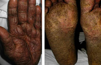 African-American woman with Sézary syndrome
