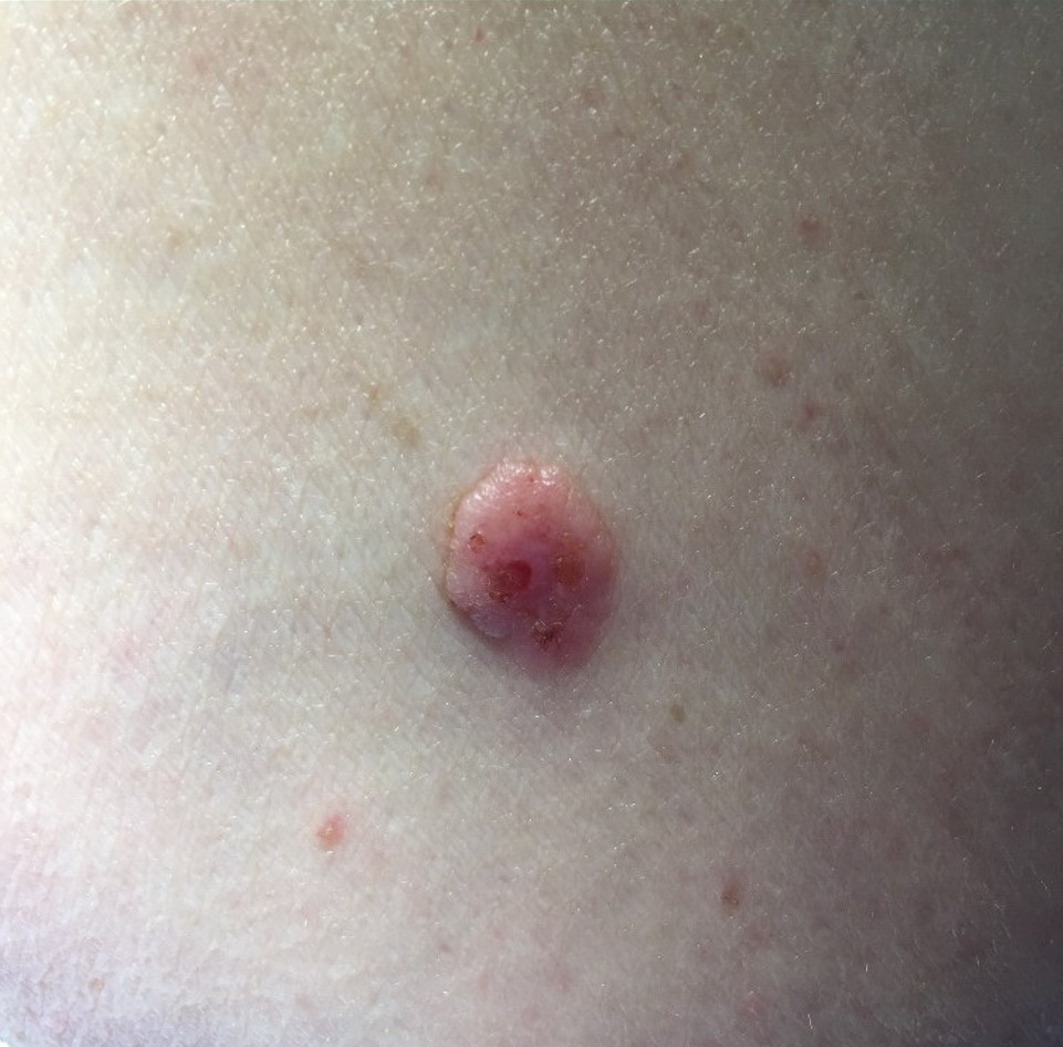 Disease Management Nonmelanoma Skin Cancer